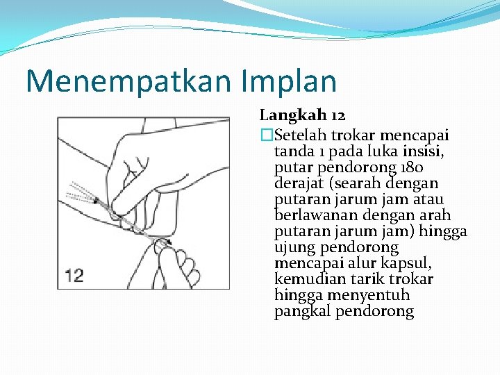 Menempatkan Implan Langkah 12 �Setelah trokar mencapai tanda 1 pada luka insisi, putar pendorong