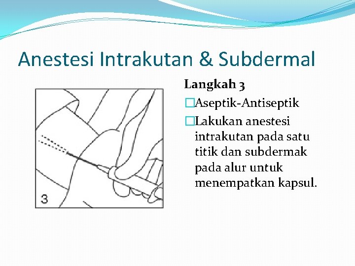 Anestesi Intrakutan & Subdermal Langkah 3 �Aseptik-Antiseptik �Lakukan anestesi intrakutan pada satu titik dan