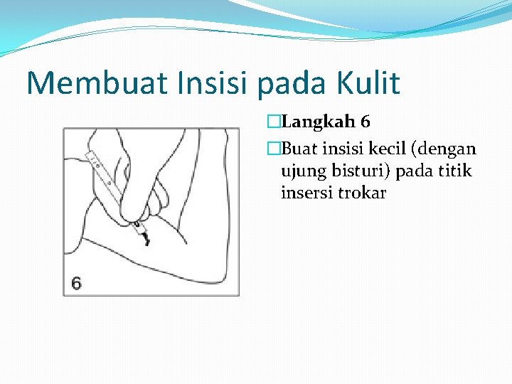 Membuat Insisi pada Kulit �Langkah 6 �Buat insisi kecil (dengan ujung bisturi) pada titik