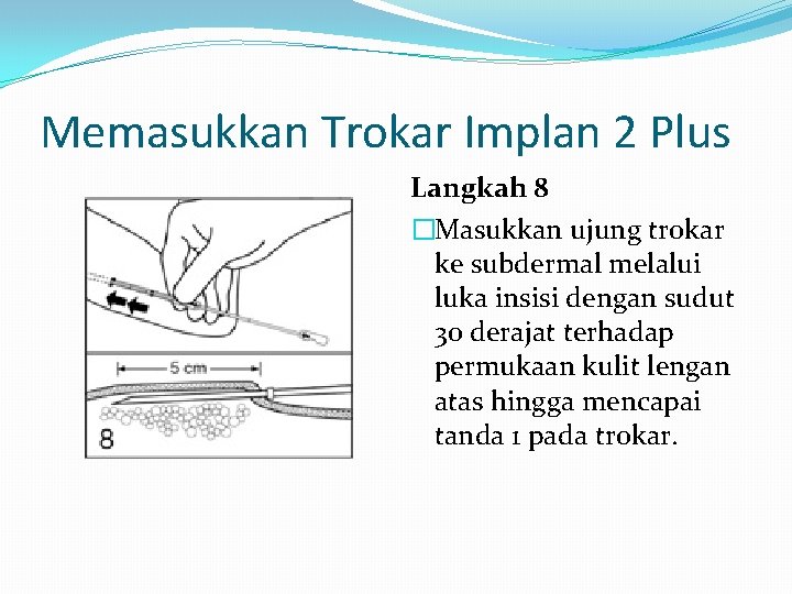 Memasukkan Trokar Implan 2 Plus Langkah 8 �Masukkan ujung trokar ke subdermal melalui luka