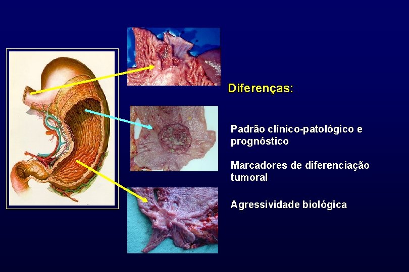 Diferenças: Padrão clínico-patológico e prognóstico Marcadores de diferenciação tumoral Agressividade biológica 