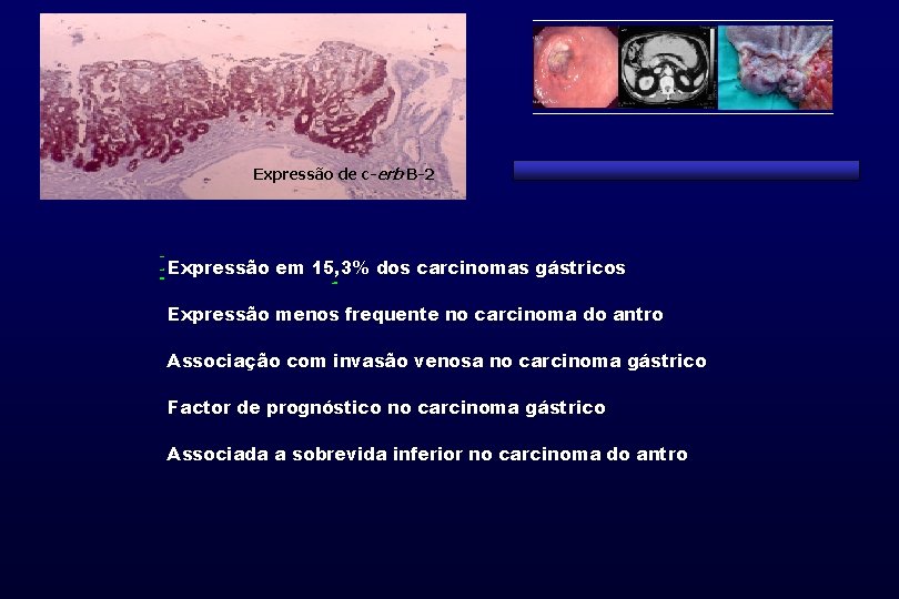Expressão de c-erb B-2 Expressão em 15, 3% dos carcinomas gástricos Expressão menos frequente