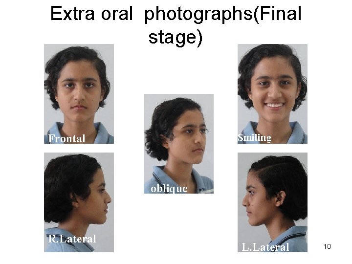 Extra oral photographs(Final stage) Smiling Frontal oblique R. Lateral L. Lateral 10 