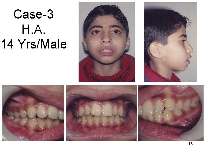 Case-3 H. A. 14 Yrs/Male 16 