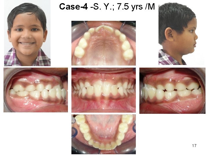 Case-4 -S. Y. ; 7. 5 yrs /M 17 