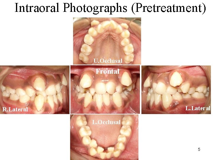 Intraoral Photographs (Pretreatment) U. Occlusal Frontal L. Lateral R. Lateral L. Occlusal 5 