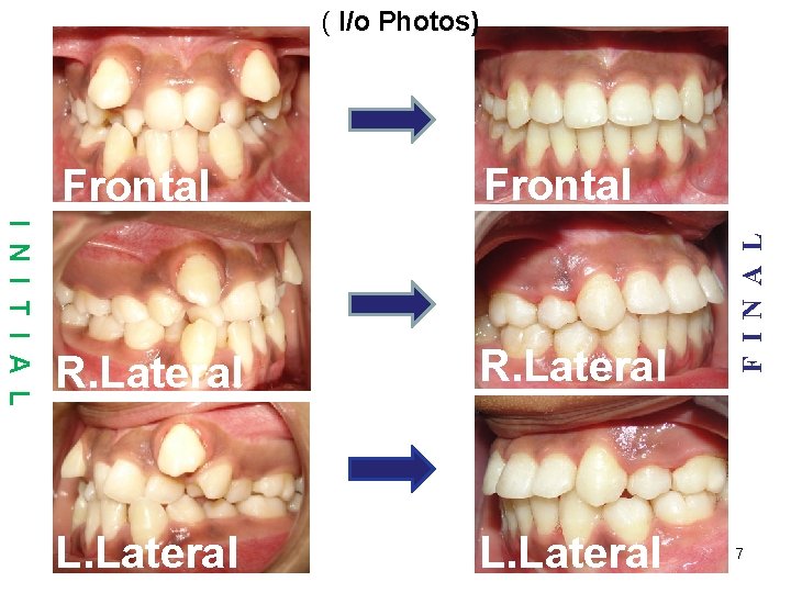 I N I T I A L Frontal R. Lateral L. Lateral F I