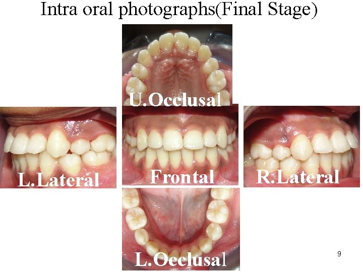 Intra oral photographs(Final Stage) U. Occlusal L. Lateral Frontal L. Occlusal R. Lateral 9