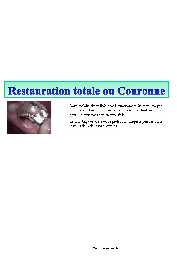 Cette molaire dévitalisée a malheureusement été restaurée par un gros plombage qui a finit