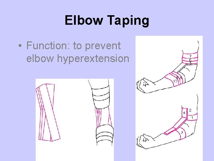 Elbow Taping • Function: to prevent elbow hyperextension 