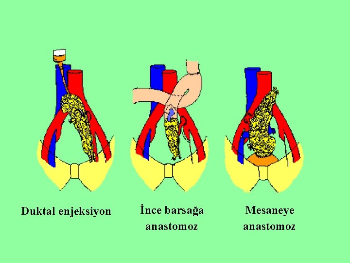 Duktal enjeksiyon İnce barsağa anastomoz Mesaneye anastomoz 