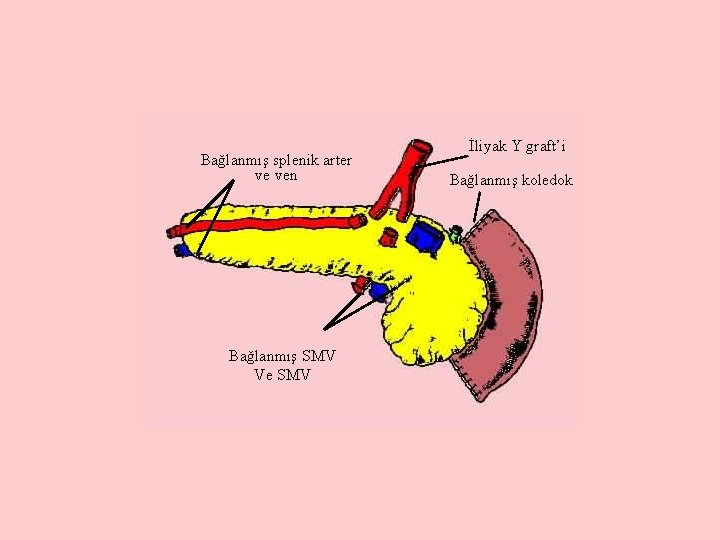 Bağlanmış splenik arter ve ven Bağlanmış SMV Ve SMV İliyak Y graft’i Bağlanmış koledok