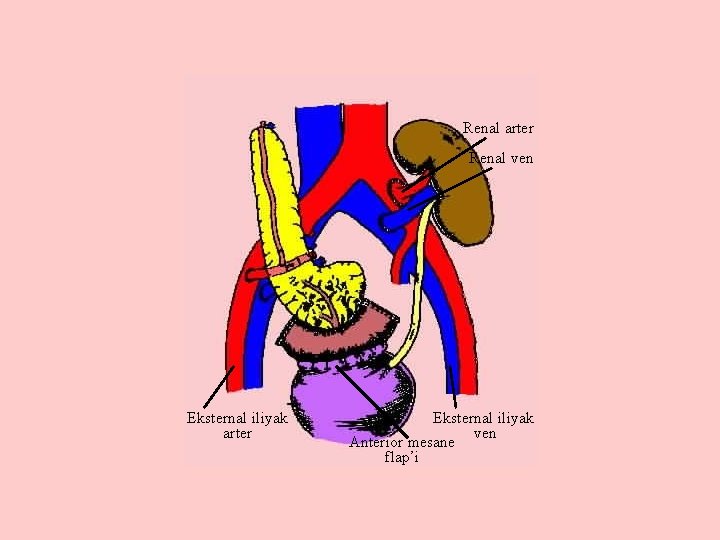 Renal arter Renal ven Eksternal iliyak arter Eksternal iliyak ven Anterior mesane flap’i 