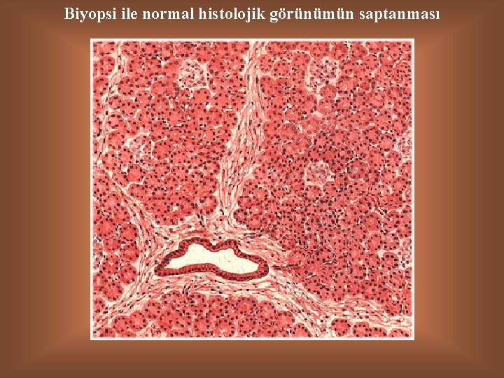 Biyopsi ile normal histolojik görünümün saptanması 