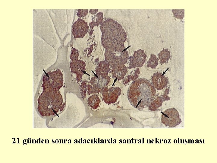 21 günden sonra adacıklarda santral nekroz oluşması 