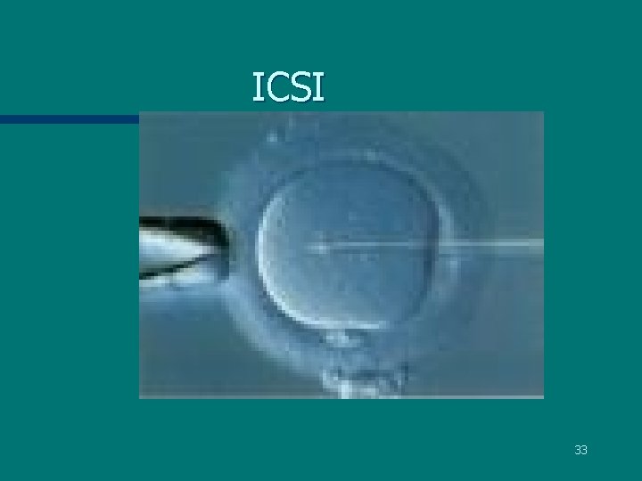 ICSI 33 