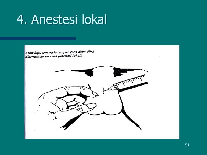 4. Anestesi lokal 51 