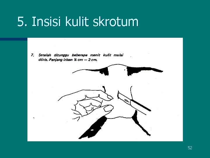 5. Insisi kulit skrotum 52 