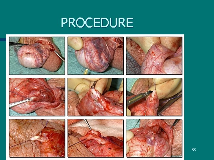 PROCEDURE 58 