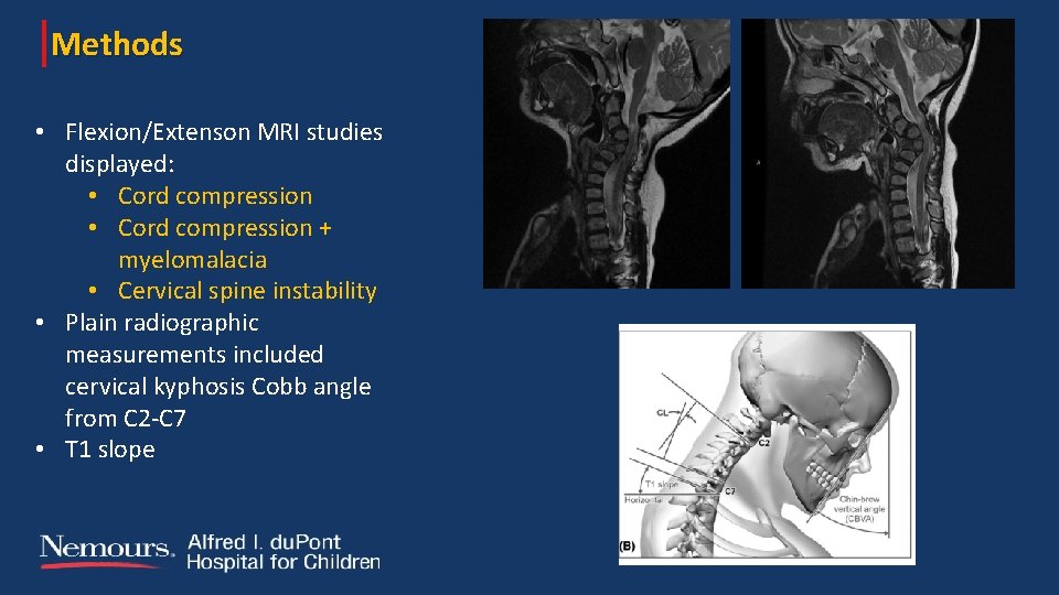 Anterior Vertebrectomy and Cervical Fusion A Technique For
