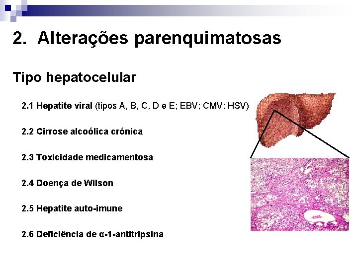 2. Alterações parenquimatosas Tipo hepatocelular 2. 1 Hepatite viral (tipos A, B, C, D