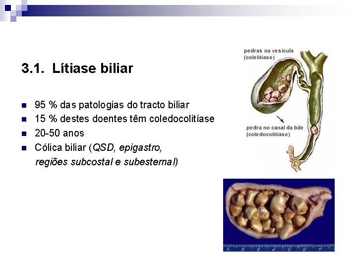 3. 1. Lítiase biliar n n 95 % das patologias do tracto biliar 15