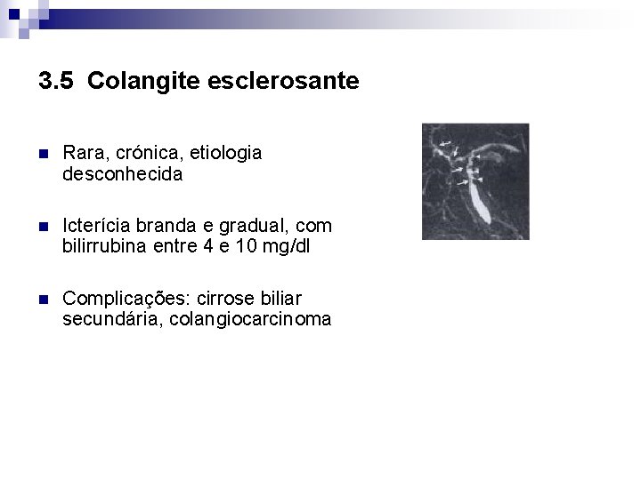 3. 5 Colangite esclerosante n Rara, crónica, etiologia desconhecida n Icterícia branda e gradual,
