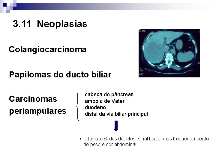 3. 11 Neoplasias Colangiocarcinoma Papilomas do ducto biliar Carcinomas periampulares cabeça do pâncreas ampola