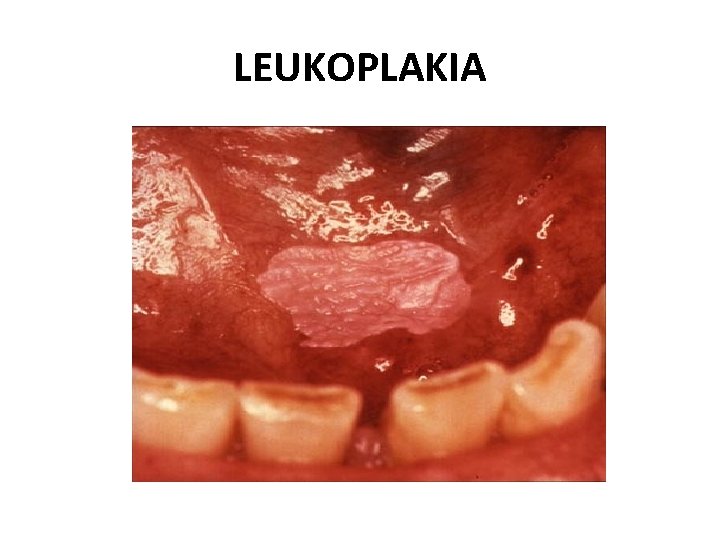 LEUKOPLAKIA 