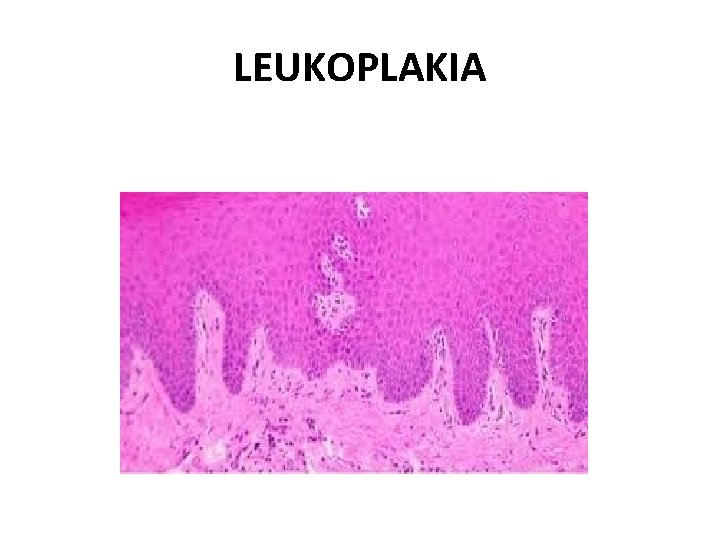 LEUKOPLAKIA 