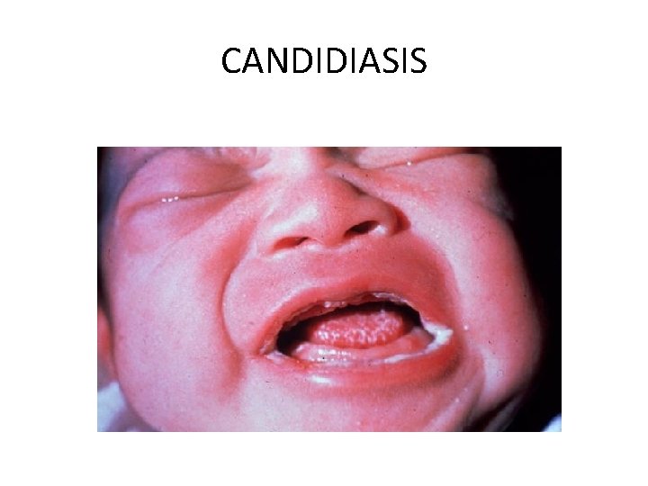 CANDIDIASIS 