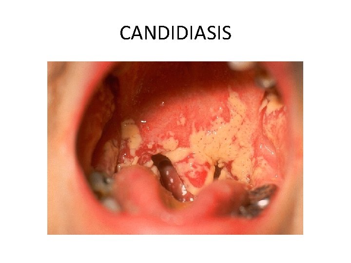 CANDIDIASIS 