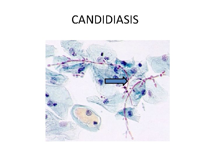 CANDIDIASIS 