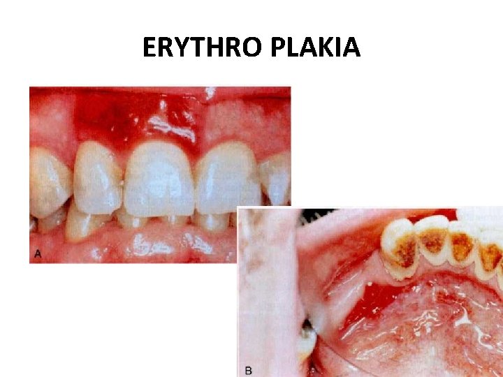 ERYTHRO PLAKIA 