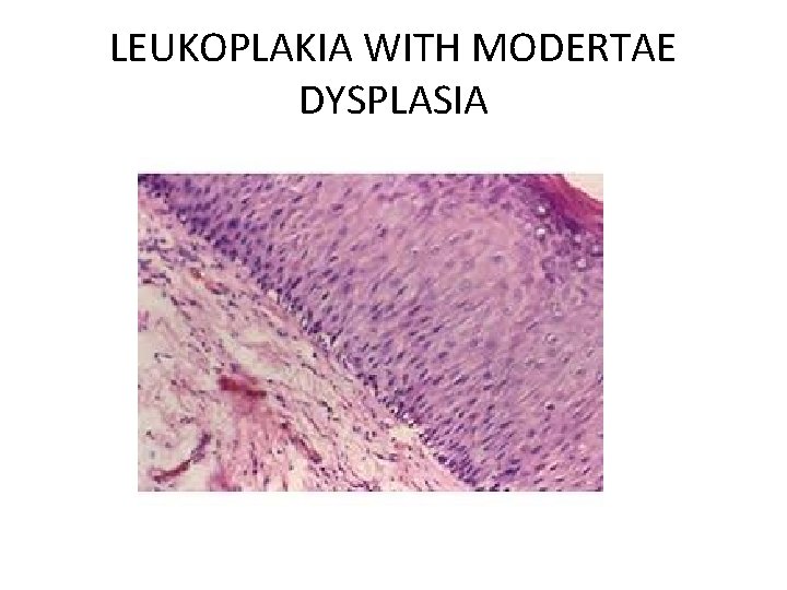 LEUKOPLAKIA WITH MODERTAE DYSPLASIA 