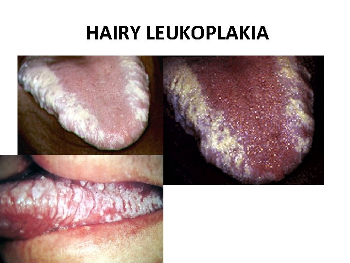 HAIRY LEUKOPLAKIA 