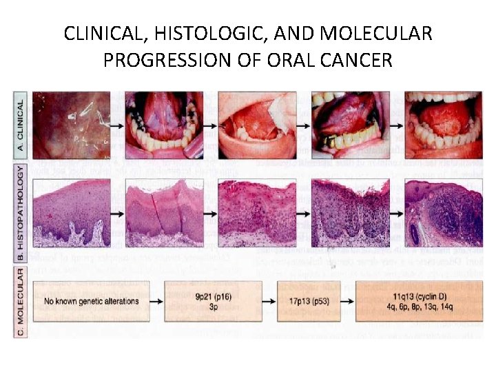 CLINICAL, HISTOLOGIC, AND MOLECULAR PROGRESSION OF ORAL CANCER 