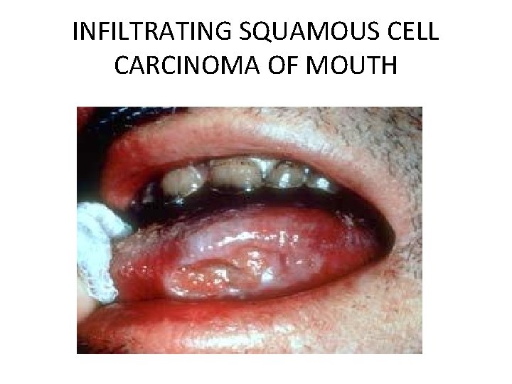 INFILTRATING SQUAMOUS CELL CARCINOMA OF MOUTH 