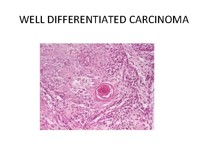 WELL DIFFERENTIATED CARCINOMA 