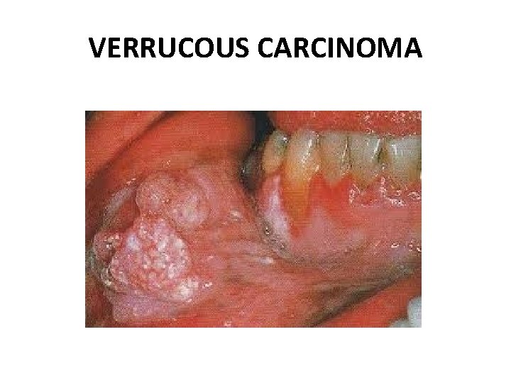 VERRUCOUS CARCINOMA 