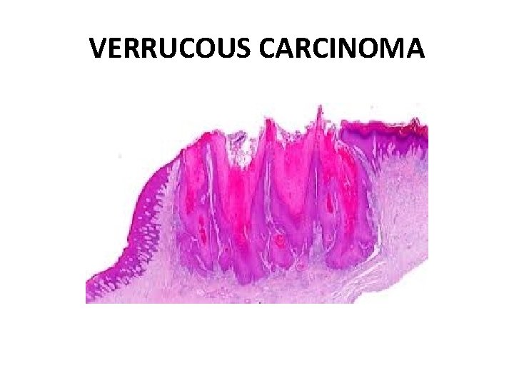 VERRUCOUS CARCINOMA 