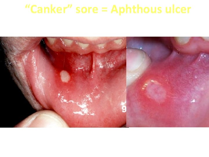 “Canker” sore = Aphthous ulcer 