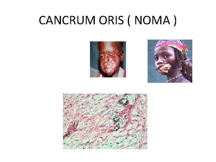 CANCRUM ORIS ( NOMA ) 