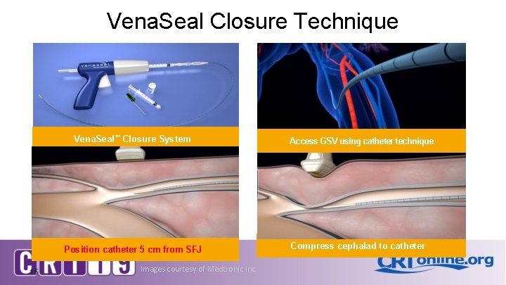 Vena. Seal Closure Technique Vena. Seal™ Closure System Position catheter 5 cm from SFJ