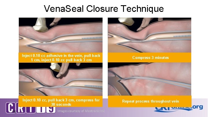 Vena. Seal Closure Technique 16 Inject 0. 10 cc adhesive in the vein, pull