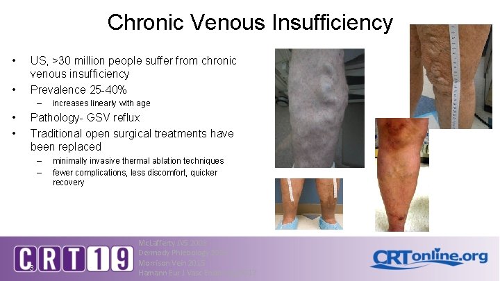 Chronic Venous Insufficiency • • US, >30 million people suffer from chronic venous insufficiency