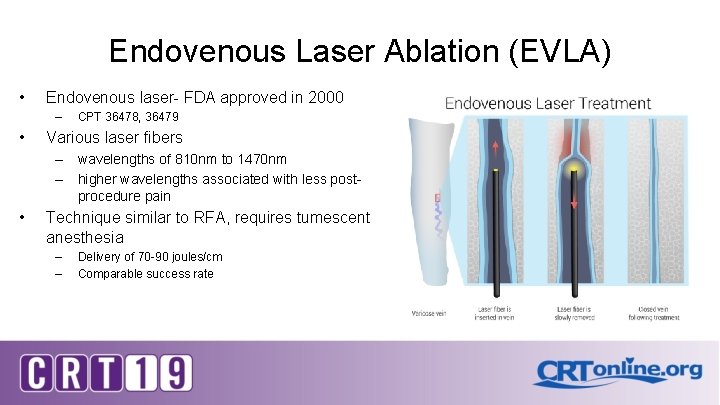 Endovenous Laser Ablation (EVLA) • Endovenous laser- FDA approved in 2000 – • CPT