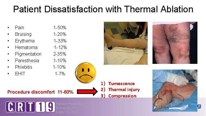 Patient Dissatisfaction with Thermal Ablation • • Pain Bruising Erythema Hematoma Pigmentation Paresthesia Phlebitis