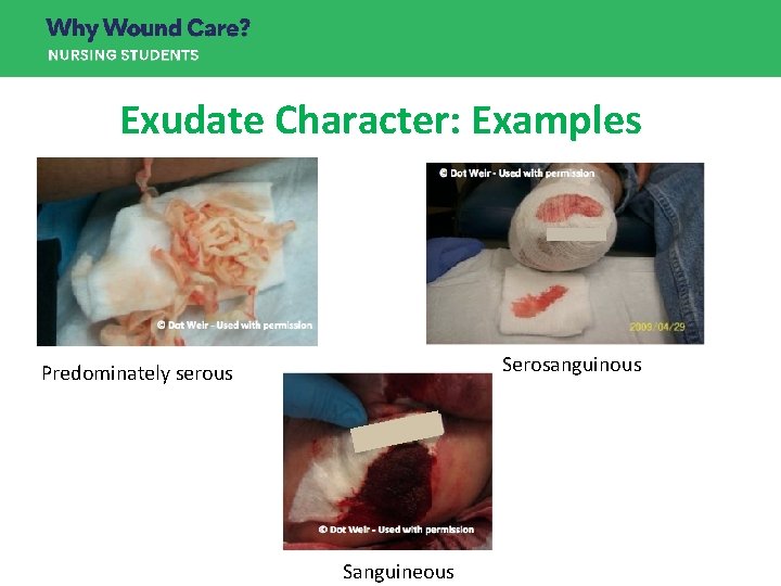 Exudate Character: Examples Serosanguinous Predominately serous Sanguineous Exudate Character: Examples Serosanguinous Predominately serous Sanguineous
