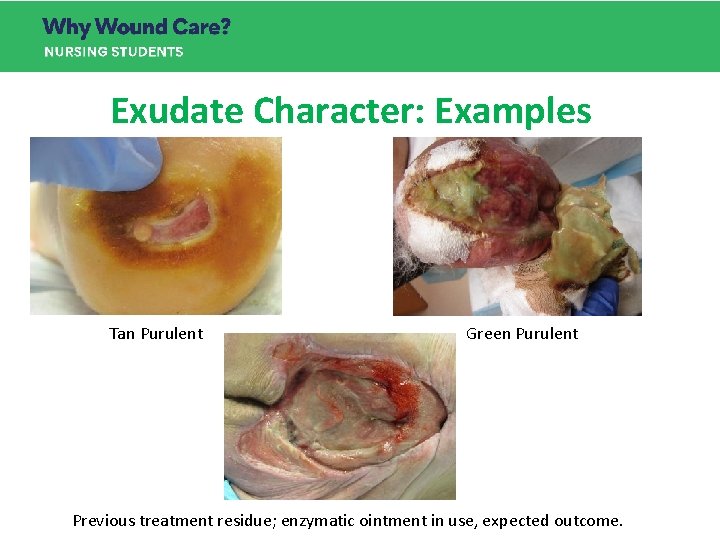 Exudate Character: Examples Tan Purulent Green Purulent Previous treatment residue; enzymatic ointment in use, Exudate Character: Examples Tan Purulent Green Purulent Previous treatment residue; enzymatic ointment in use,